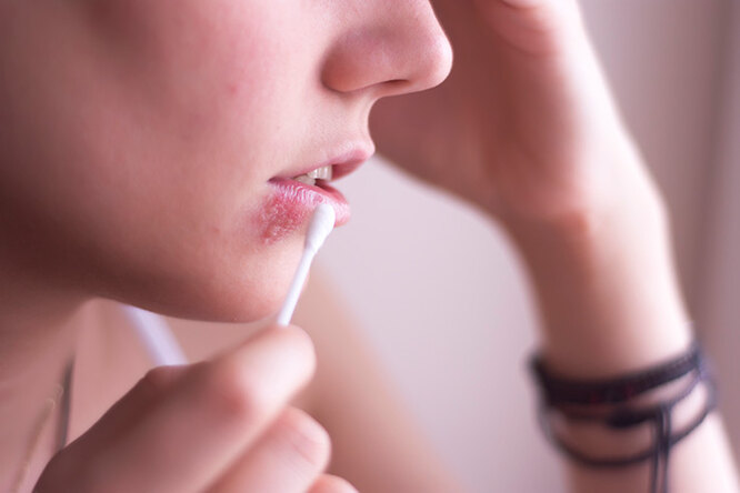 Как предотвратить герпес после увеличения губ: причины появления инфекции и способы ее избежать