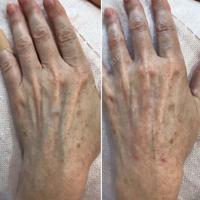 Как выглядят руки после контурной пластики — процедуры против сухости и старения кожи