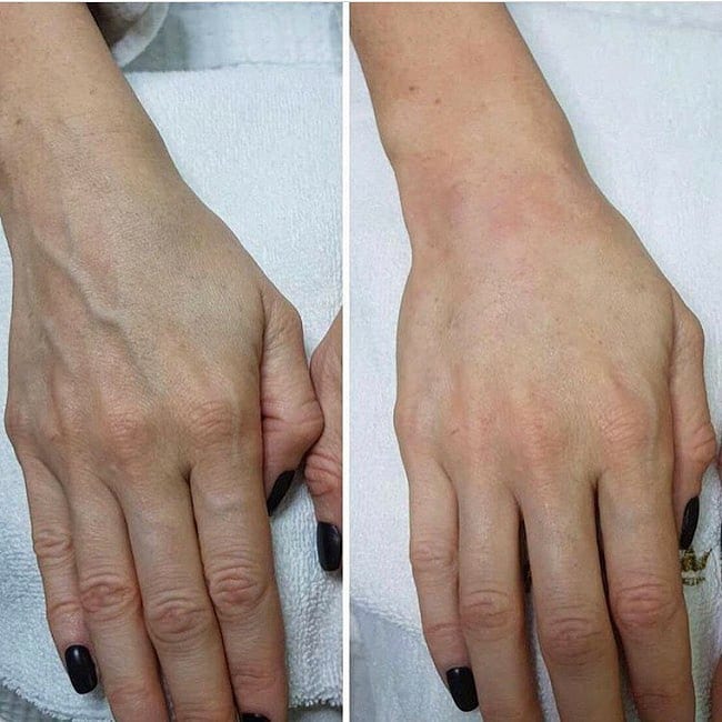 Как выглядят руки после контурной пластики — процедуры против сухости и старения кожи
