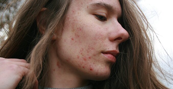 Учимся ухаживать за подростковой кожей