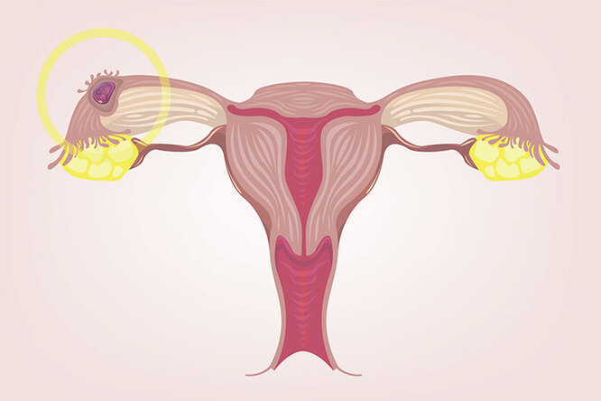 Что такое внематочная беременность и почему она возникает